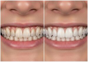 before-and-after-comparison-of-a-smile-enhanced-with-composite-veneers