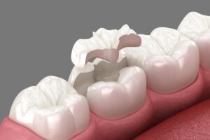 Inlay,Ceramic,Crown,Placement.,Medically
